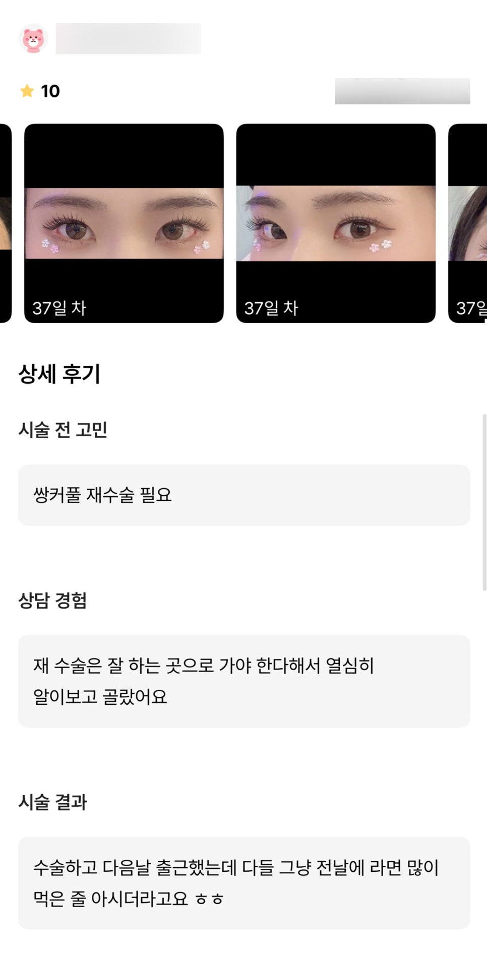 눈재수술 후기."그냥 부은줄 알 정도로 자연스러웠어요!" 관련 이미지 1