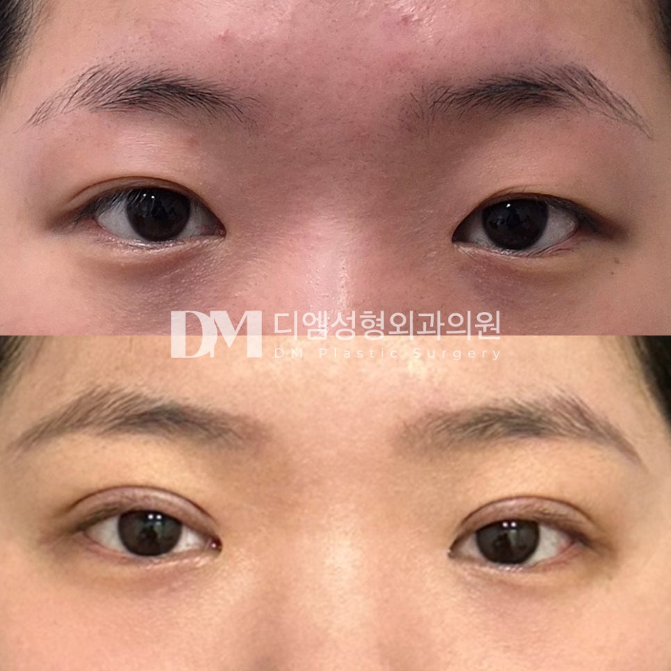 눈재수술 후기."라인도 너무 맘에들고 주변에서도 잘된 것 같다고 해서 너무 만족입니다!" 관련 이미지 2