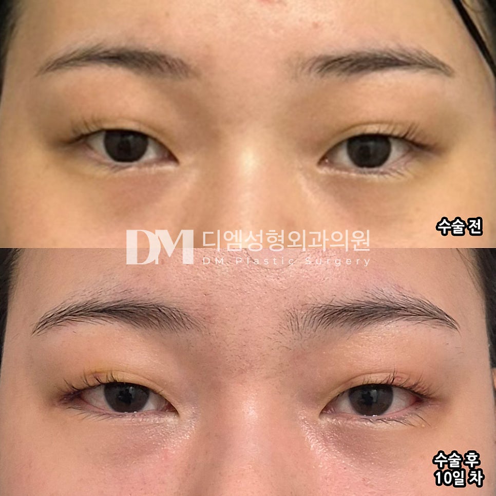 Bbangtwiem Review. "The effects showed right away, and I really liked it!" image 2