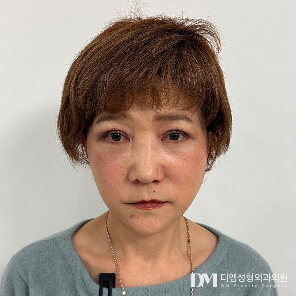 하안검, 미적 개선과 기능 회복까지 동시에! 관련 이미지 2
