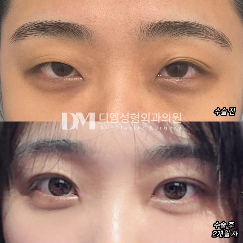 눈매교정, 겹주름 진 눈두덩이로 피곤해 보인다면? 관련 이미지 12