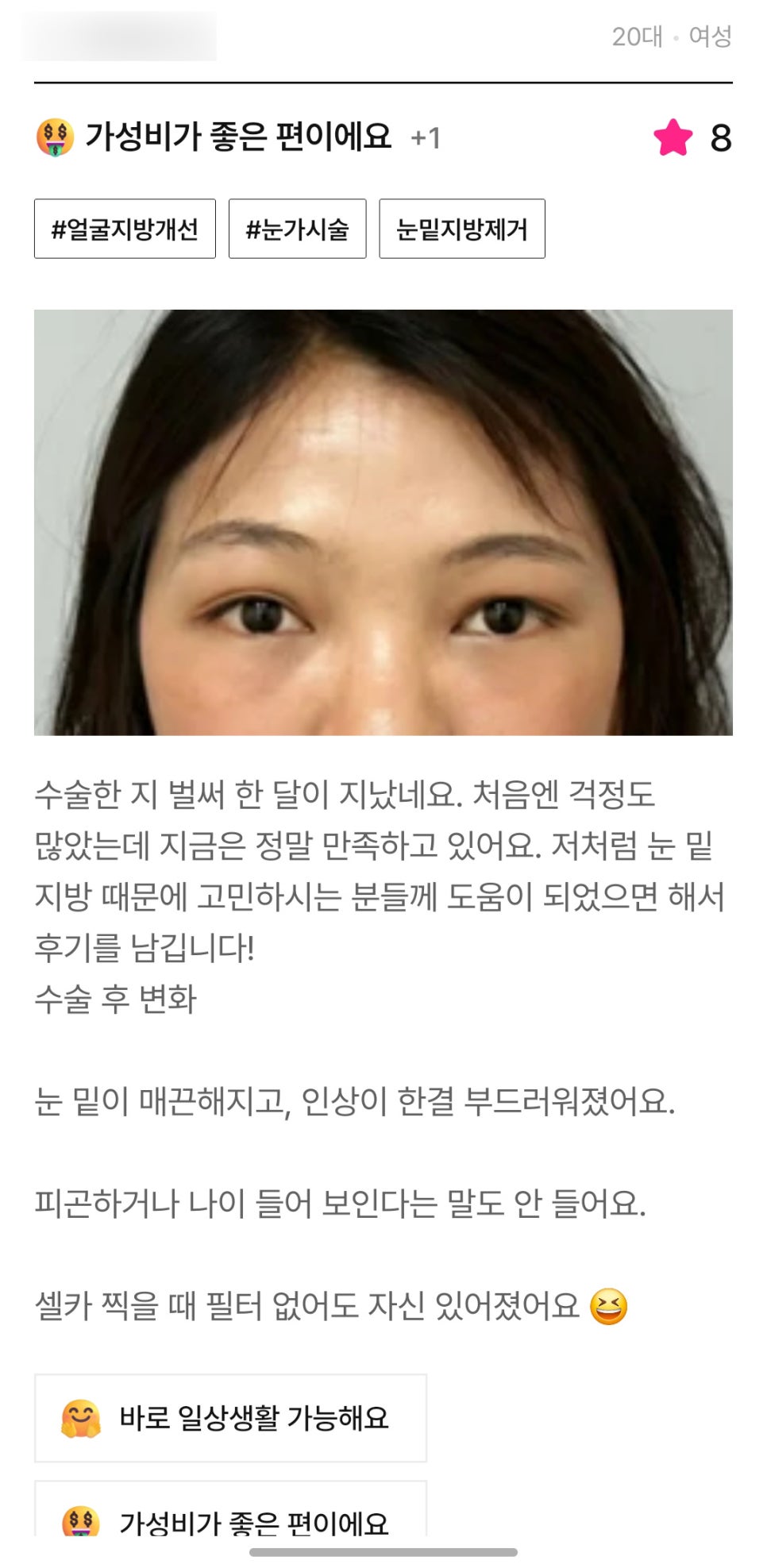 눈밑지방재배치 후기."눈 밑이 매끈해지고 인상이 한결 부드러워졌어요" 관련 이미지 1