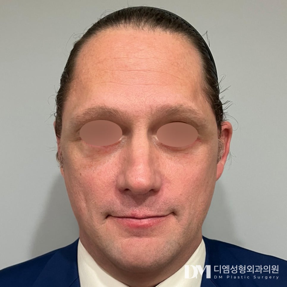Partial Facelift: Concerned About Drooping Eyes and Wrinkles Around the Eyes? image 8