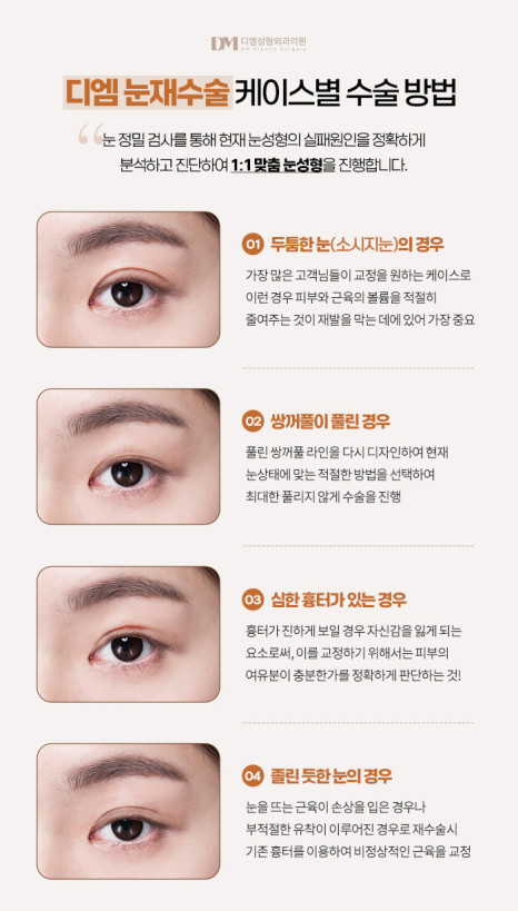 눈재수술, 쌍꺼풀이 풀려 비대칭 눈매가 되었다면? 관련 이미지 6