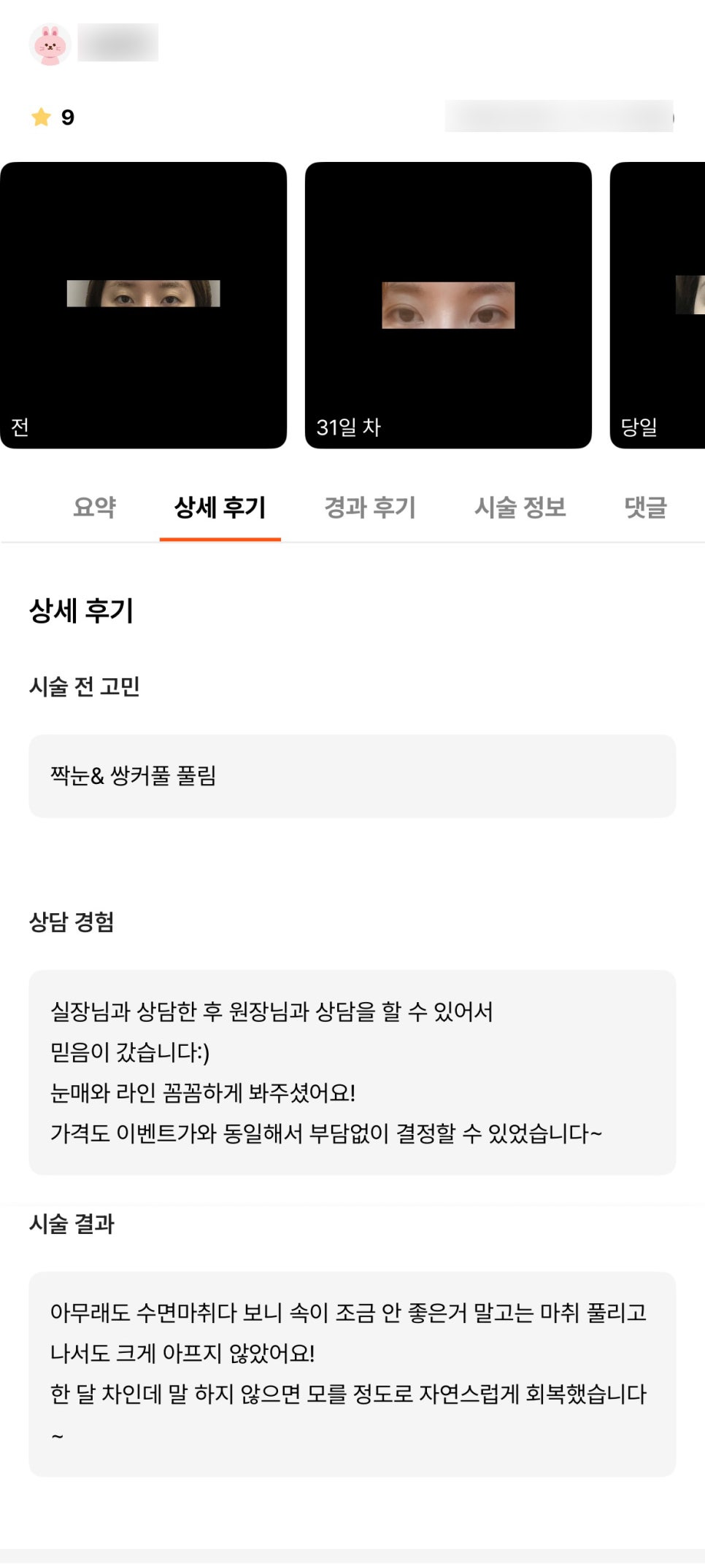 눈재수술 후기."말하지 않으면 모를 정도로 자연스러워요!" 관련 이미지 1