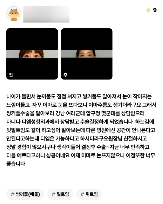 Blepharoplasty Review: "I’m so satisfied, and everyone says I look pretty, so it was a success!" image 1