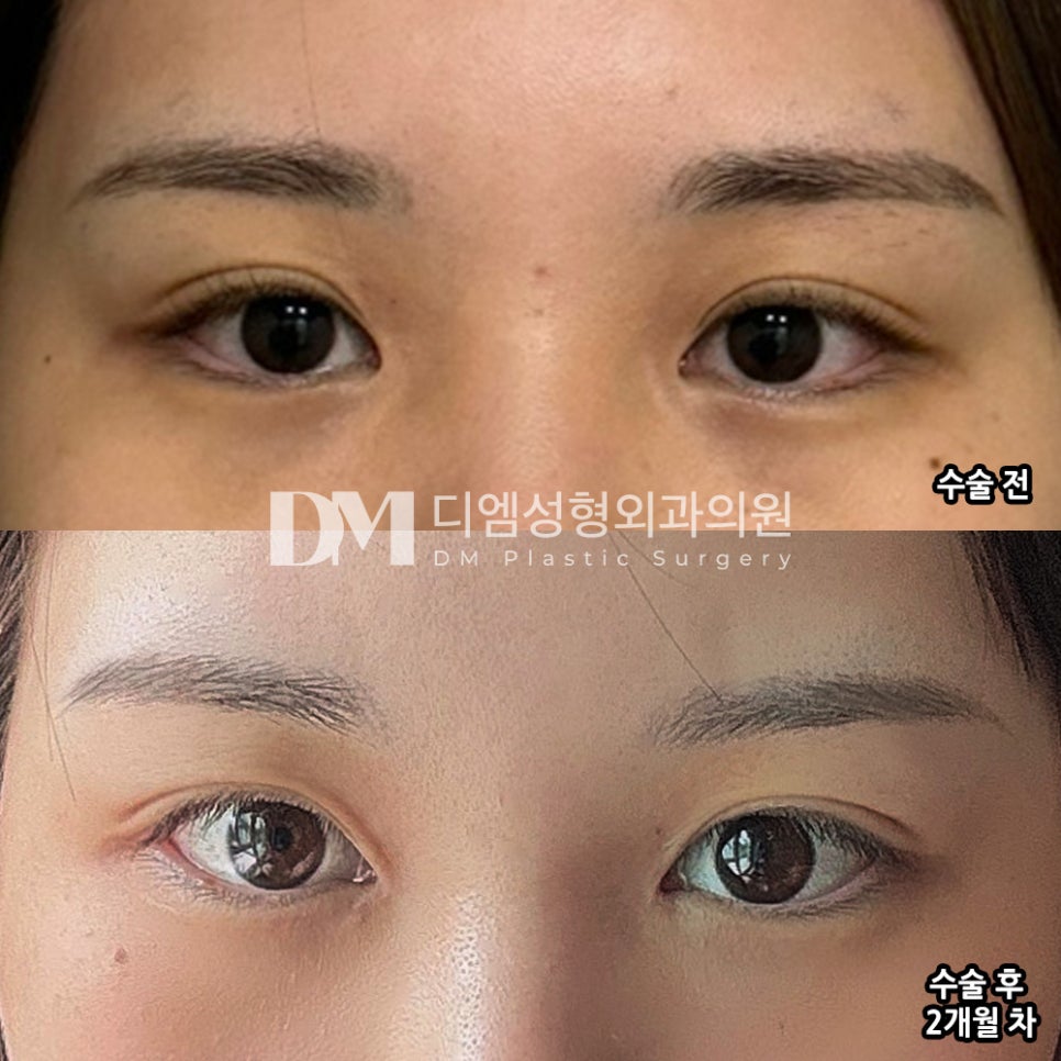 앞트임 후기."부자연스럽지 않고 정말 깔끔하게 잘 됐어요!" 관련 이미지 2
