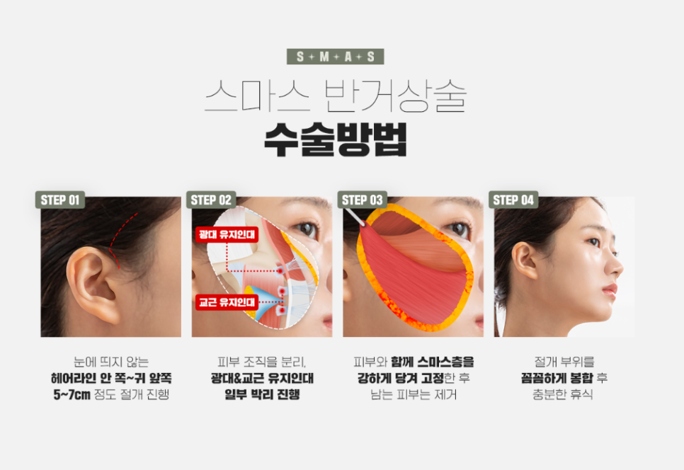 반거상, 안면거상은 부담스러웠다면 주목! 관련 이미지 10