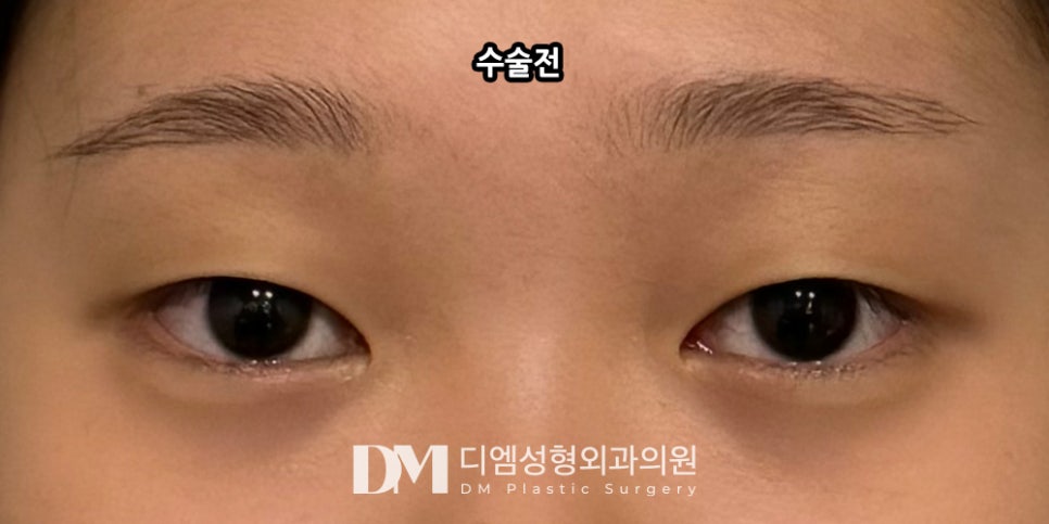 눈매교정, 이미지와 기능까지 동시개선 ! 관련 이미지 12