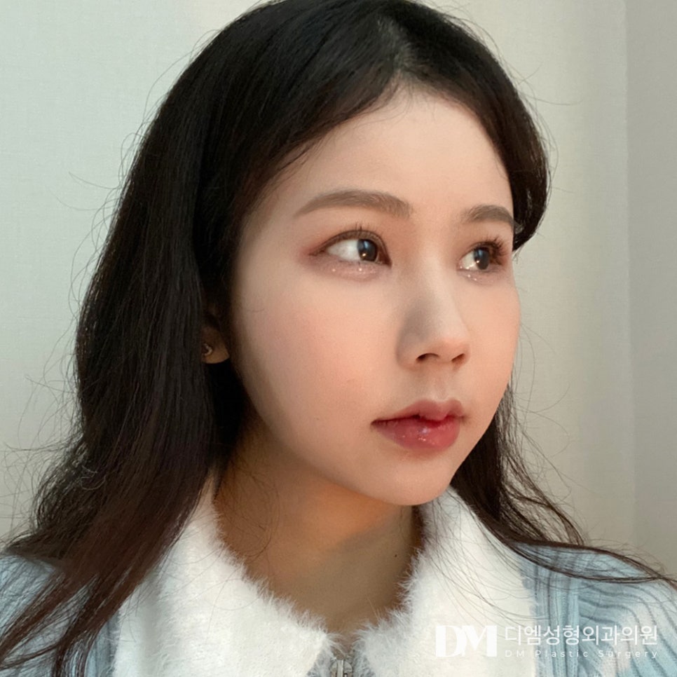 눈밑지방재배치, 불룩해진 눈밑 매끈하게 되살리기! 관련 이미지 10