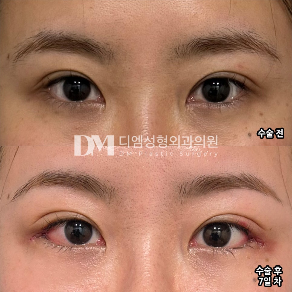 Bangteum Review. “I was told it would be possible to get after-sales service, so I decided to have the surgery!” image 2