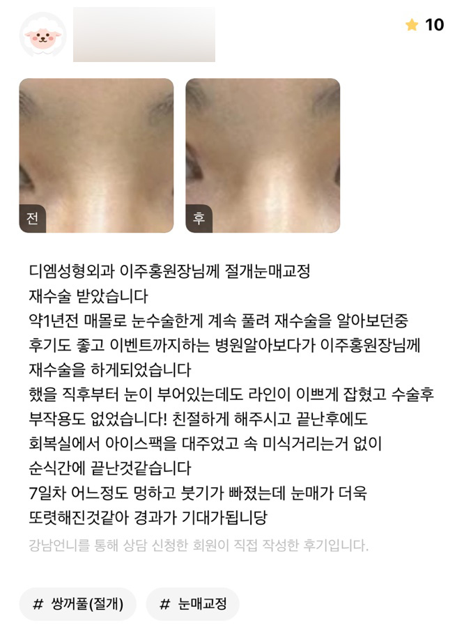 눈재수술 후기."눈매가 더욱 또렷해진 것 같아 기대가 됩니다 !" 관련 이미지 1