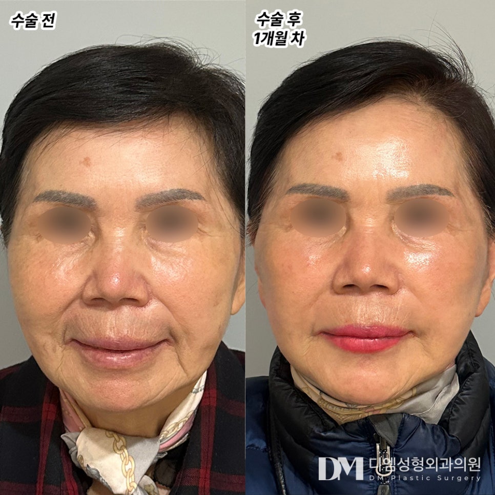 Facelift Revision Surgery Review. "I’m happy that the recovery is fast too!" image 2