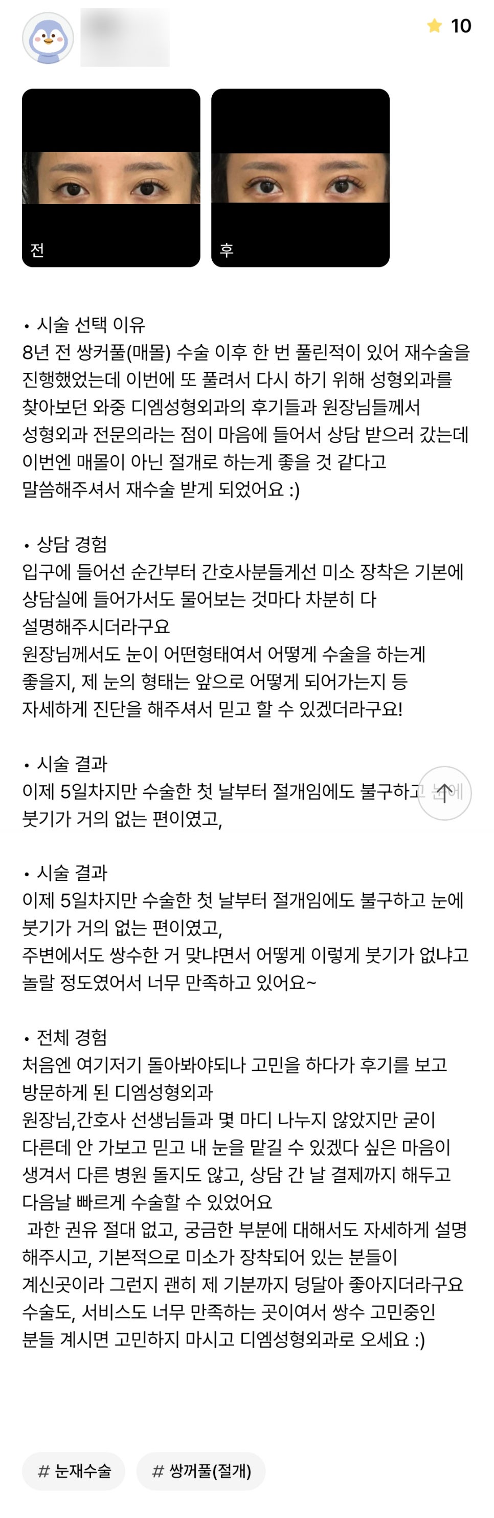 눈재수술 후기."어떻게 이렇게 붓기가 없냐고 놀랄 정도였어서 너무 만족하고 있어요! " 관련 이미지 1