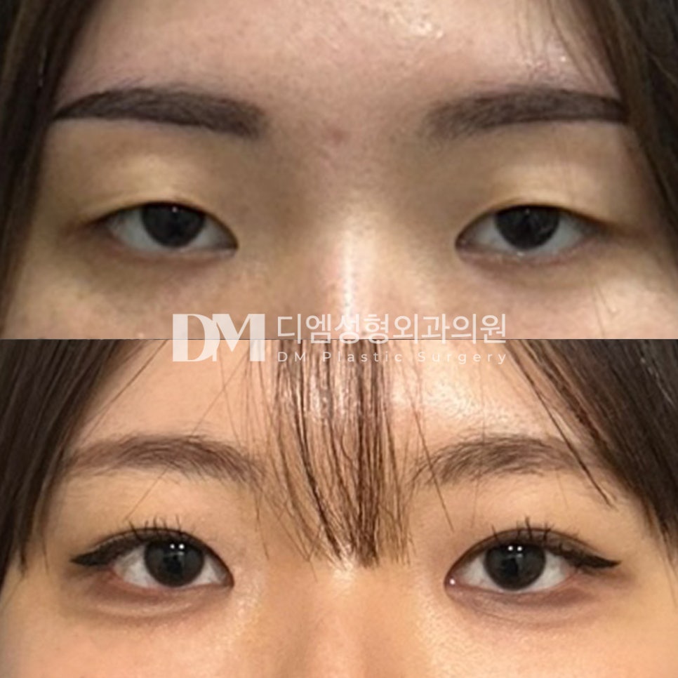 눈성형 후기."자연스럽게 눈이 커져서 만족해요!" 관련 이미지 2