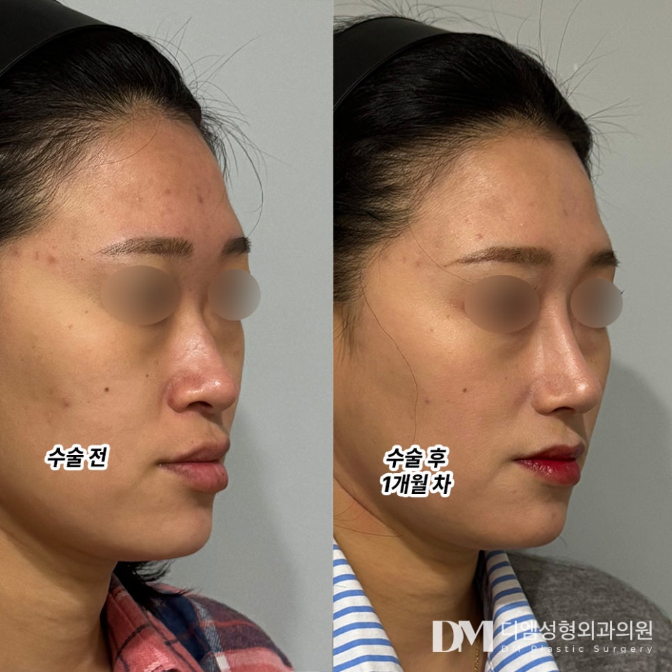 코성형 후기."다들 성숙하고 지적여 보인대요 !" 관련 이미지 2