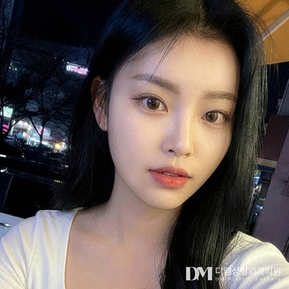디엠 뒤밑트임 전후사진, 눈꼬리만 달라져도 인상이 바뀔까? 관련 이미지 1