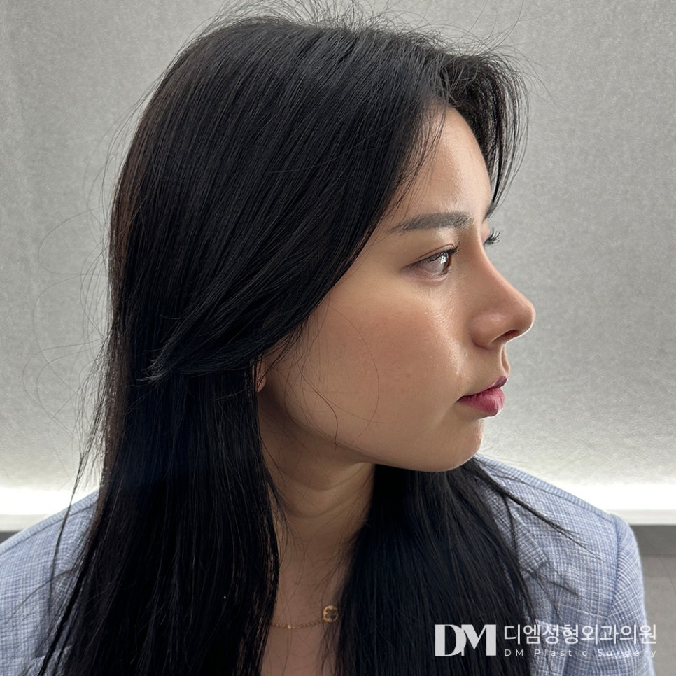 Facial Fat Grafting: Can It Improve Volume and Make You Look Younger? image 1