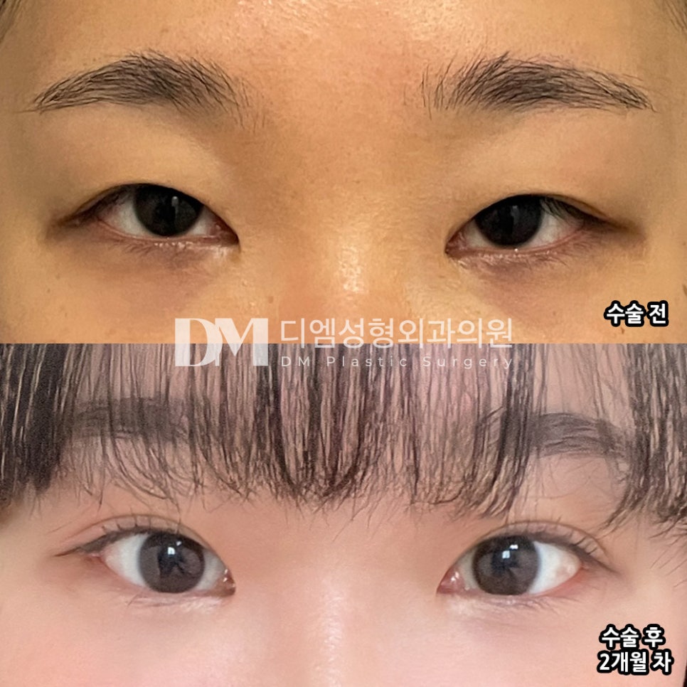 Revision Eyelid Surgery Review: “I’m satisfied because it looks more natural than before!” image 2