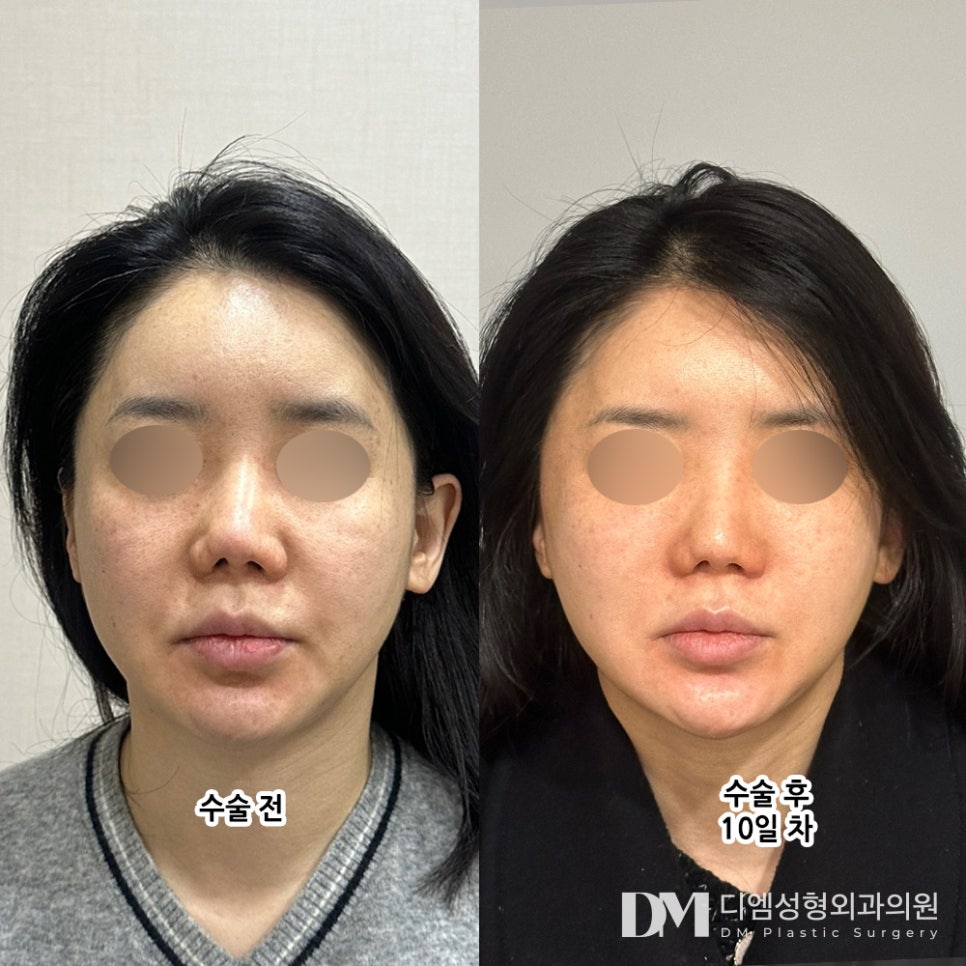 반거상, 안면거상은 부담스러웠다면 주목! 관련 이미지 7