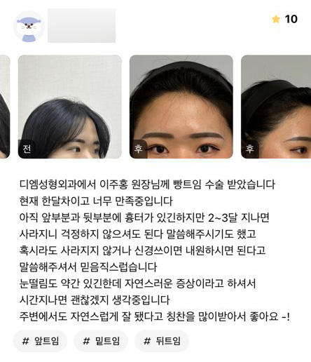 트임성형 후기."자연스럽게 잘 됐다고 칭찬을 많이받아서 좋아요!" 관련 이미지 1