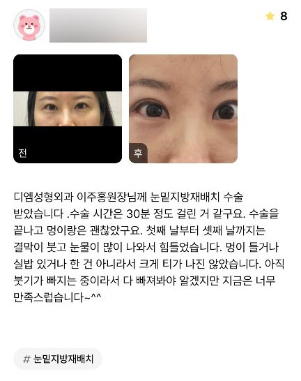 눈밑지방재배치 후기."너무 만족스럽습니다!" 관련 이미지 1