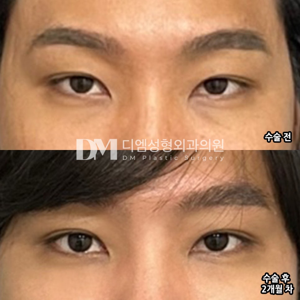 눈재수술 후기." 라인도 원하는 모양대로 잘 잡아주셔서 자리를 완벽하게 잡은 것 같습니다." 관련 이미지 2