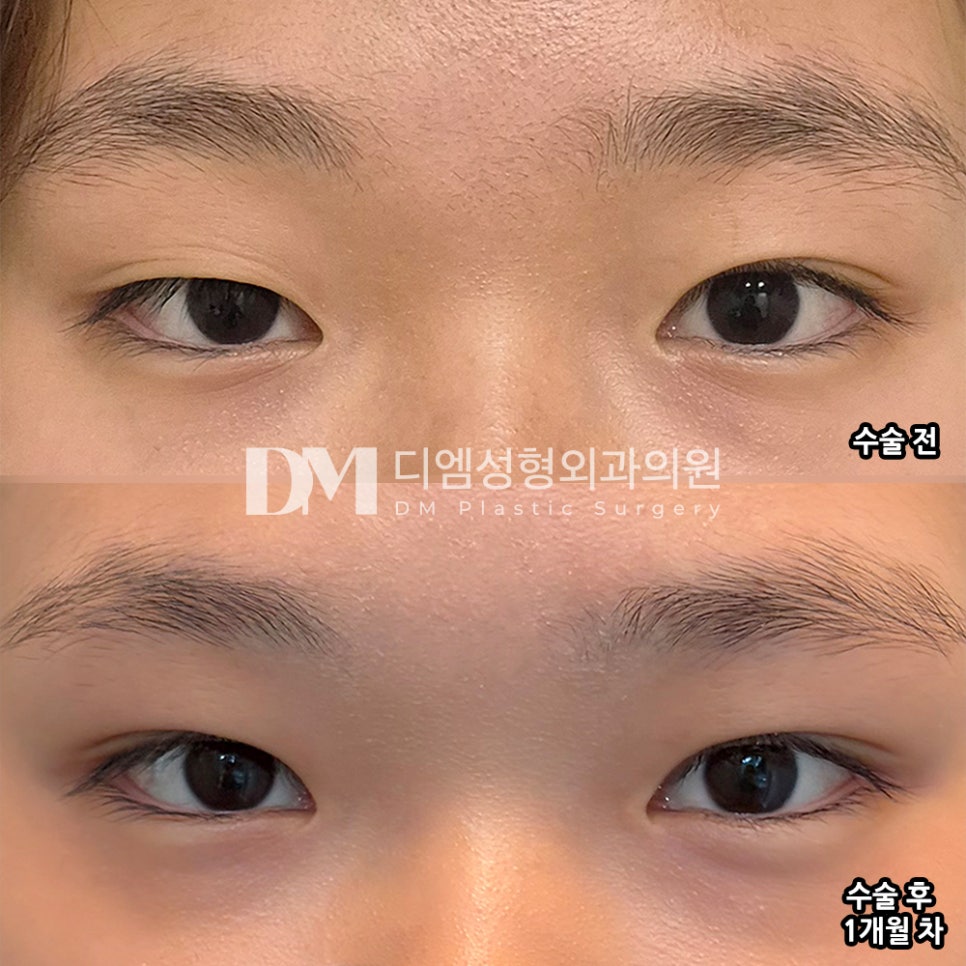 디엠 쌍꺼풀/눈성형 후기, &ldquo;쌍꺼풀 자연스럽게 잘됐습니다!&rdquo; 관련 이미지 2