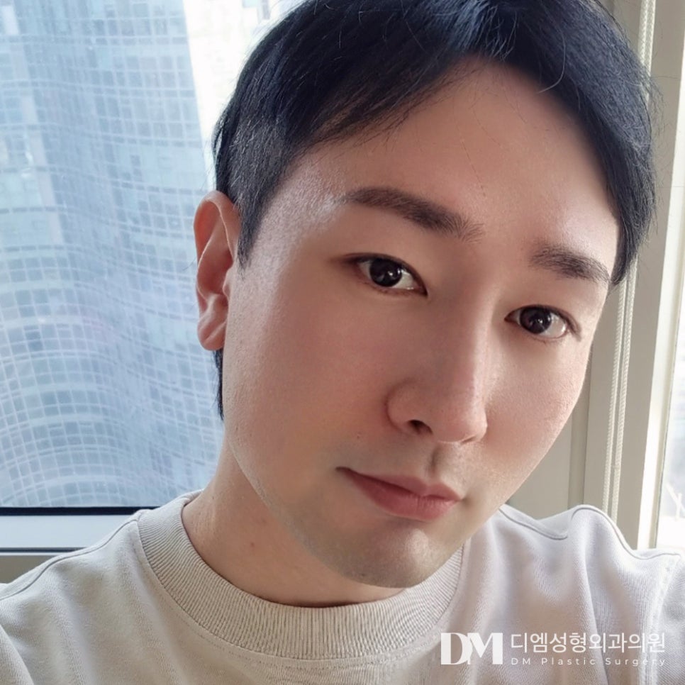 짧은코성형, 무조건 늘리고 높이기 보다 자연스럽게 맞춤형으로! 관련 이미지 1
