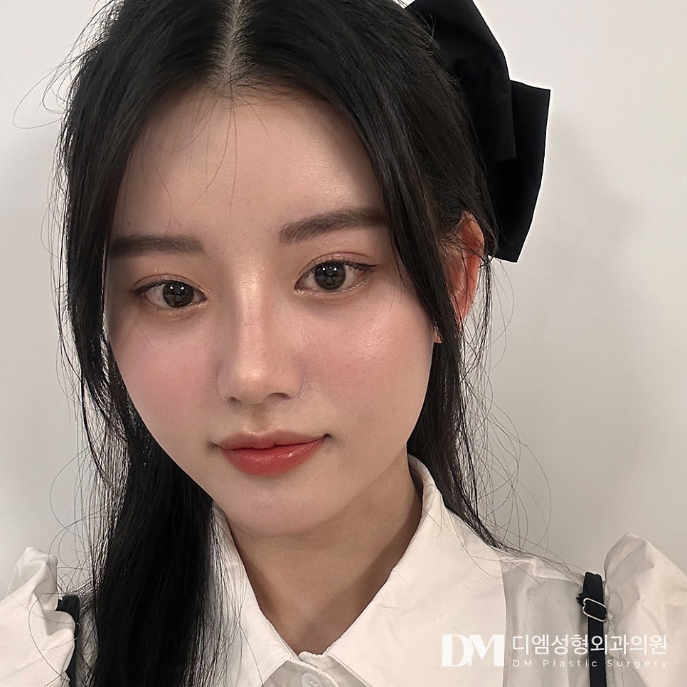 동양인에 흔한 짧은코 수술방법과 주의해야 할 점은? 관련 이미지 12