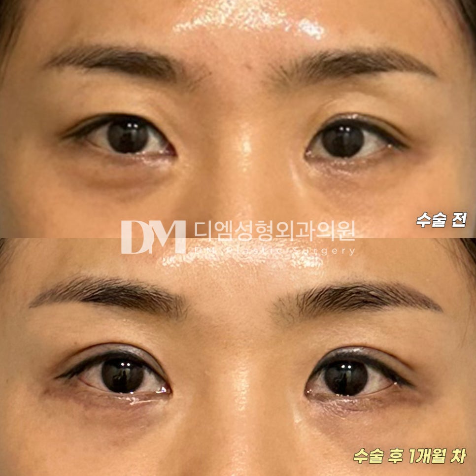 Upper Blepharoplasty Review. "I’m happy because the swelling is minor and recovery is fast!" image 2