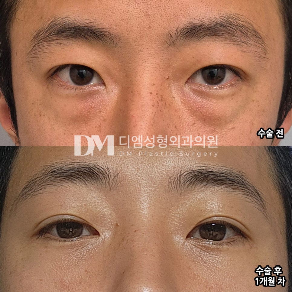 Under-Eye Fat Repositioning: Improving a Dark and Depressed Impression image 6