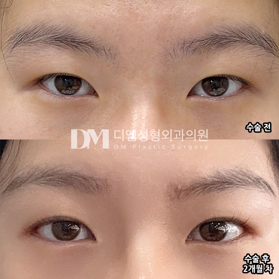 디엠 빵트임/트임성형 후기, &ldquo;원장님, 직원분들이 모두 친절하게 대해주셨어요!&rdquo; 관련 이미지 2