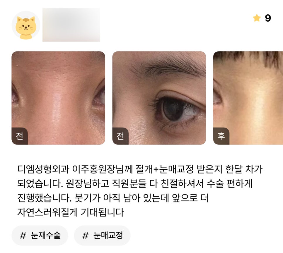 Revision Eyelid Surgery Review: “I’m Looking Forward to Looking More Natural from Here On!” image 1
