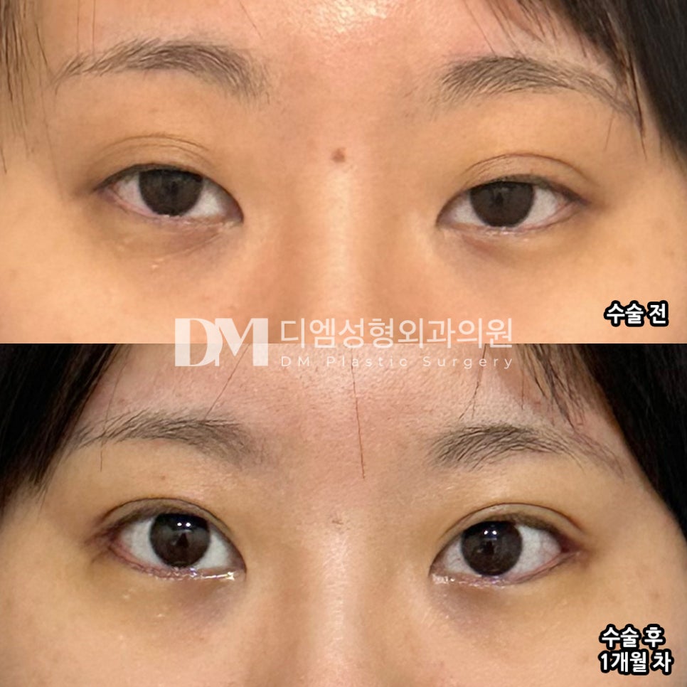 Post-Op Review of Lower and Outer Canthoplasty: "Overall, I’m satisfied, and it was a procedure I don’t regret" image 2