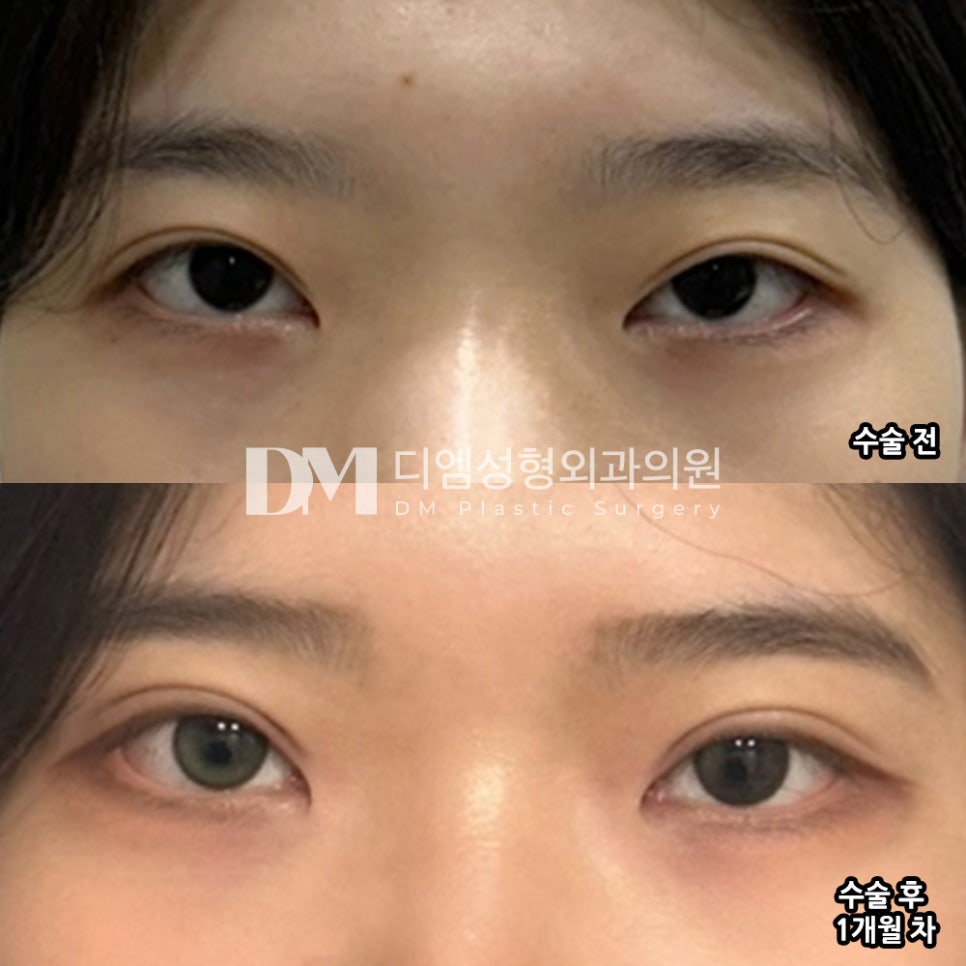 Revision Eyelid Surgery Review: “Now that it looks more natural, I feel more confident when putting on makeup and taking photos!” image 2