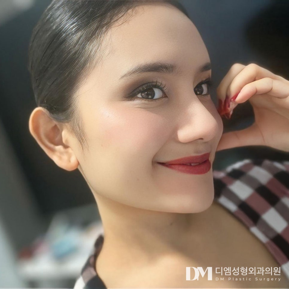 How to Achieve Satisfying Results with Low-Nose Rhinoplasty in a Single Surgery, Without Revision?! image 1