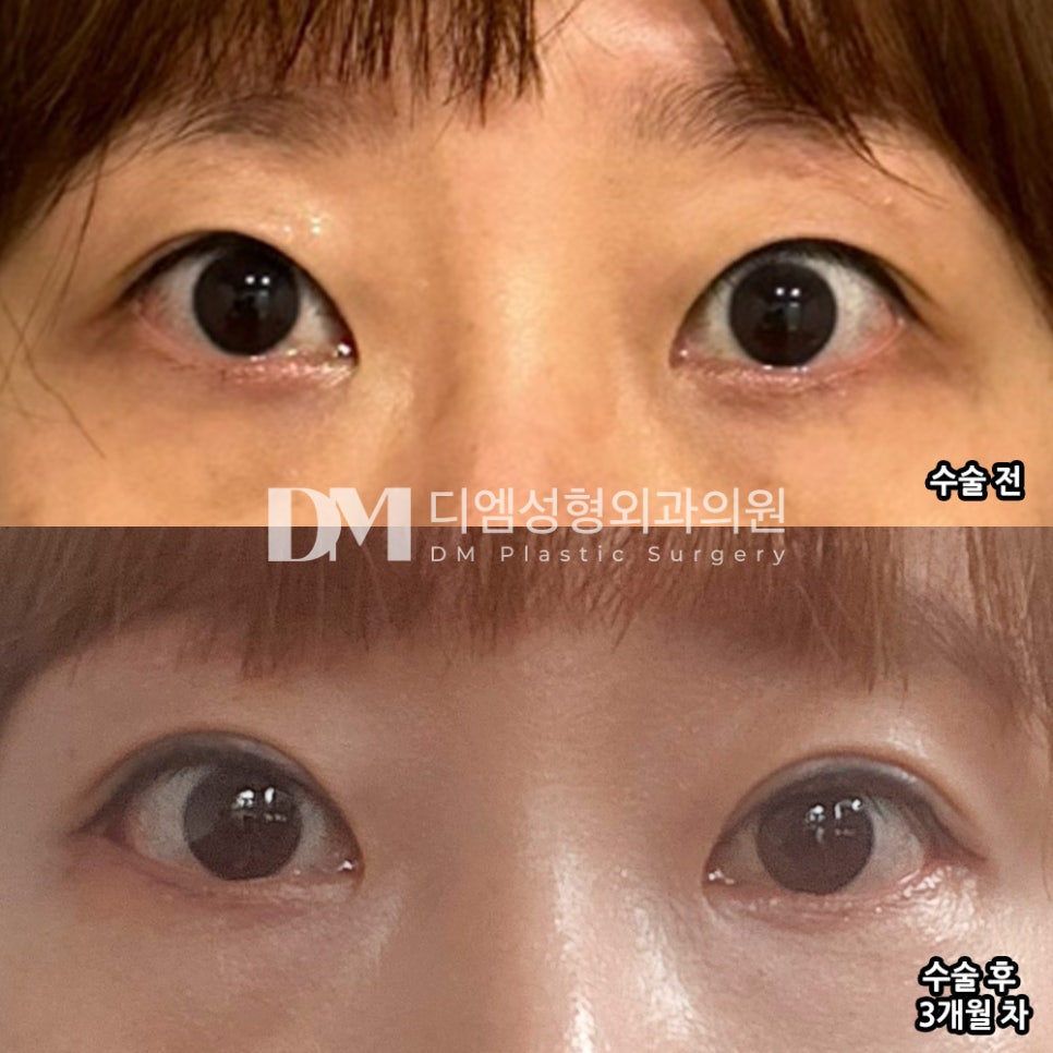 눈성형 후기."눈이 훨씬 또렷해지고 커졌어요!" 관련 이미지 2