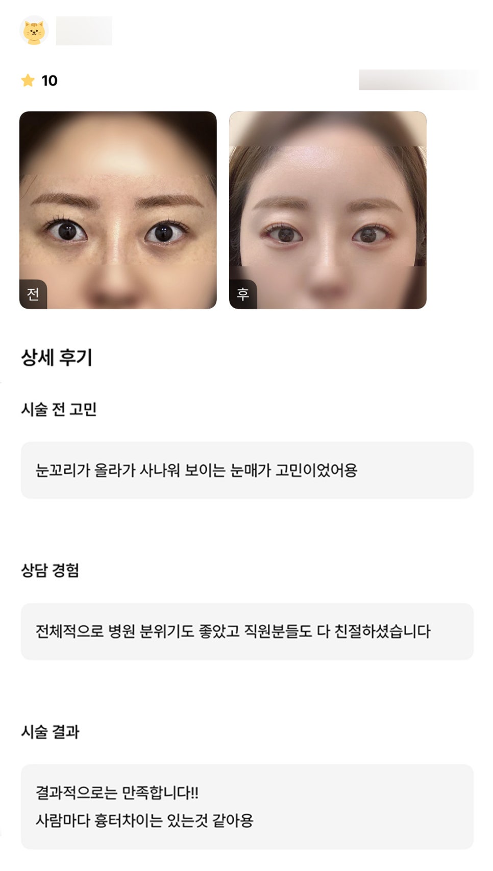 Post-Op Review of Lateral and Lower Canthoplasty. “Everyone was kind, and overall, I’m satisfied!” image 1