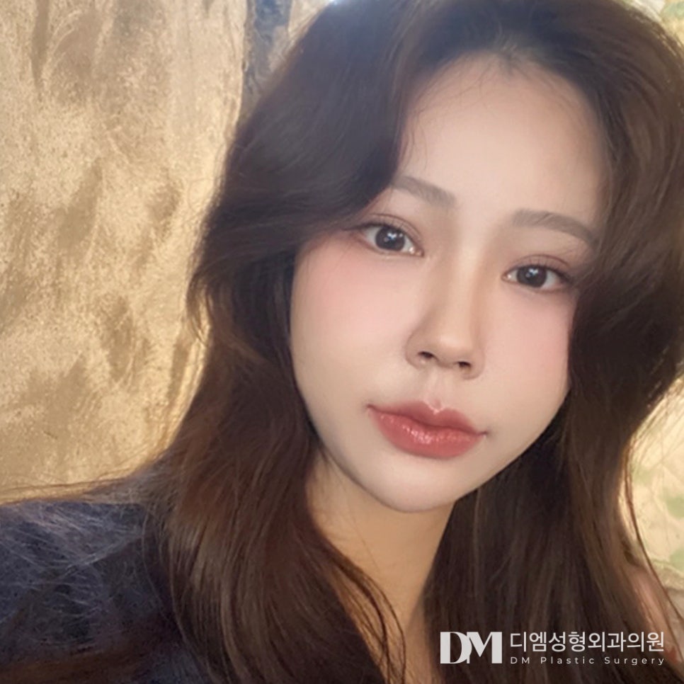 DM Lower Eyelid Fat Repositioning Review Photos: Smooth Under-Eyes Without Visible Hollows! image 3