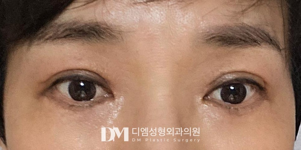 하안검, 눈밑지방이 불룩해 더 나이들어 보인다면? 관련 이미지 8
