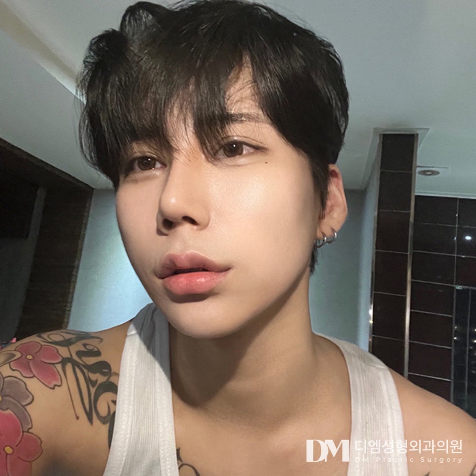 디엠 남자코성형 전후사진, 코 하나로 달라지는 인상! 관련 이미지 1