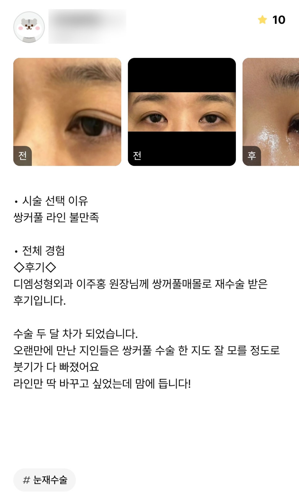 눈재수술 후기."라인만 딱 바꾸고싶었는데 맘에 듭니다!" 관련 이미지 1