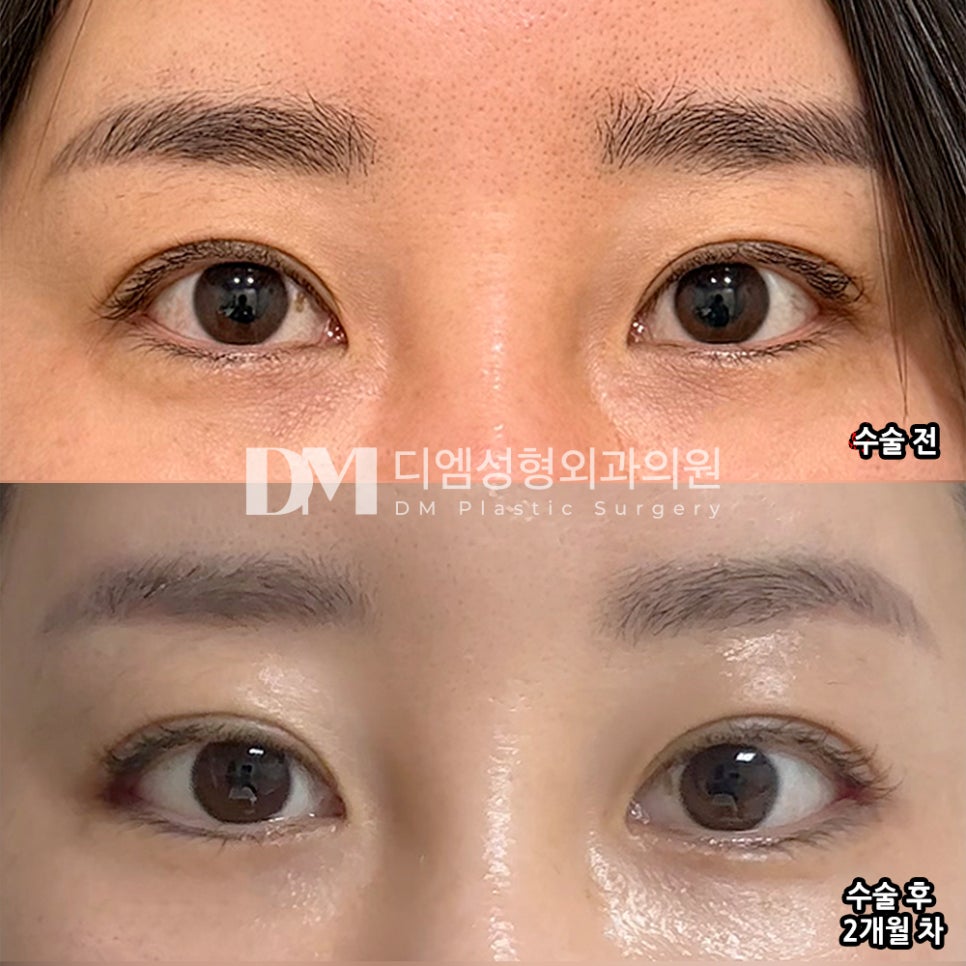 디엠 뒤밑트임 전후사진, 자연스럽게 눈매 확장을 원한다면! 관련 이미지 2
