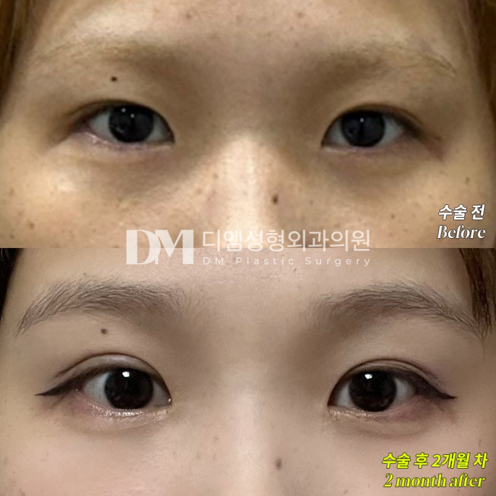 Review of Revision Eye Surgery. "Everyone was so kind, and I’m very happy with the results!" image 2