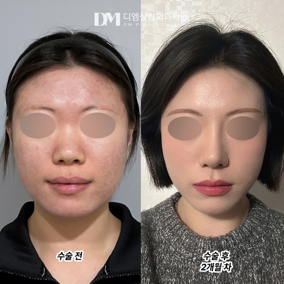 디엠 코성형 전후사진, 뭉툭한 코끝 탈출! 자려한 코로 변신! 관련 이미지 2