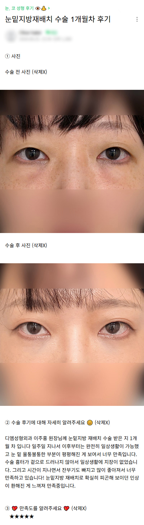 디엠 눈밑지방재배치 수술후기, &ldquo;피곤해 보이던 인상이 환해졌어요!&rdquo; 관련 이미지 1