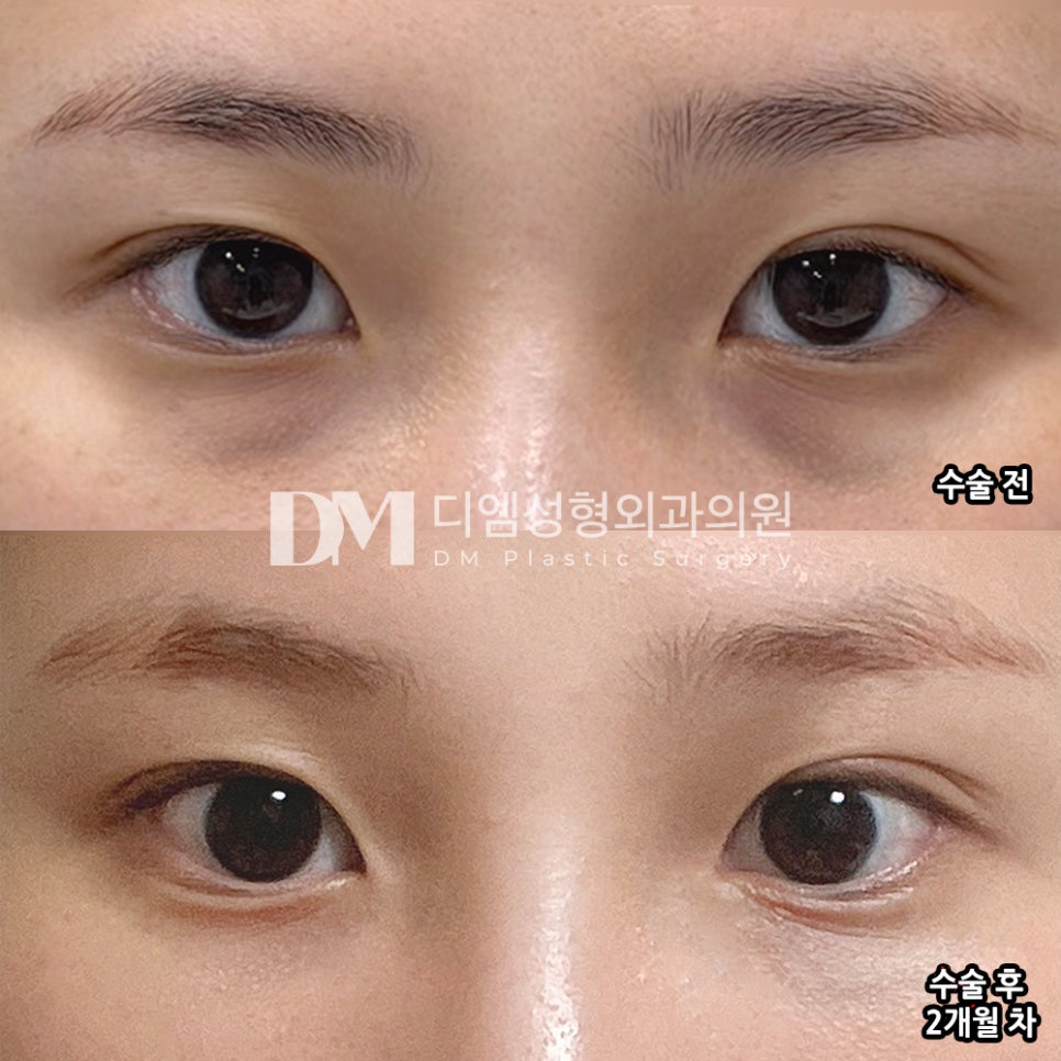 디엠 눈밑지방재배치 전후사진, 피곤해 보이는 인상, 눈 밑부터 확인해 보세요! 관련 이미지 2