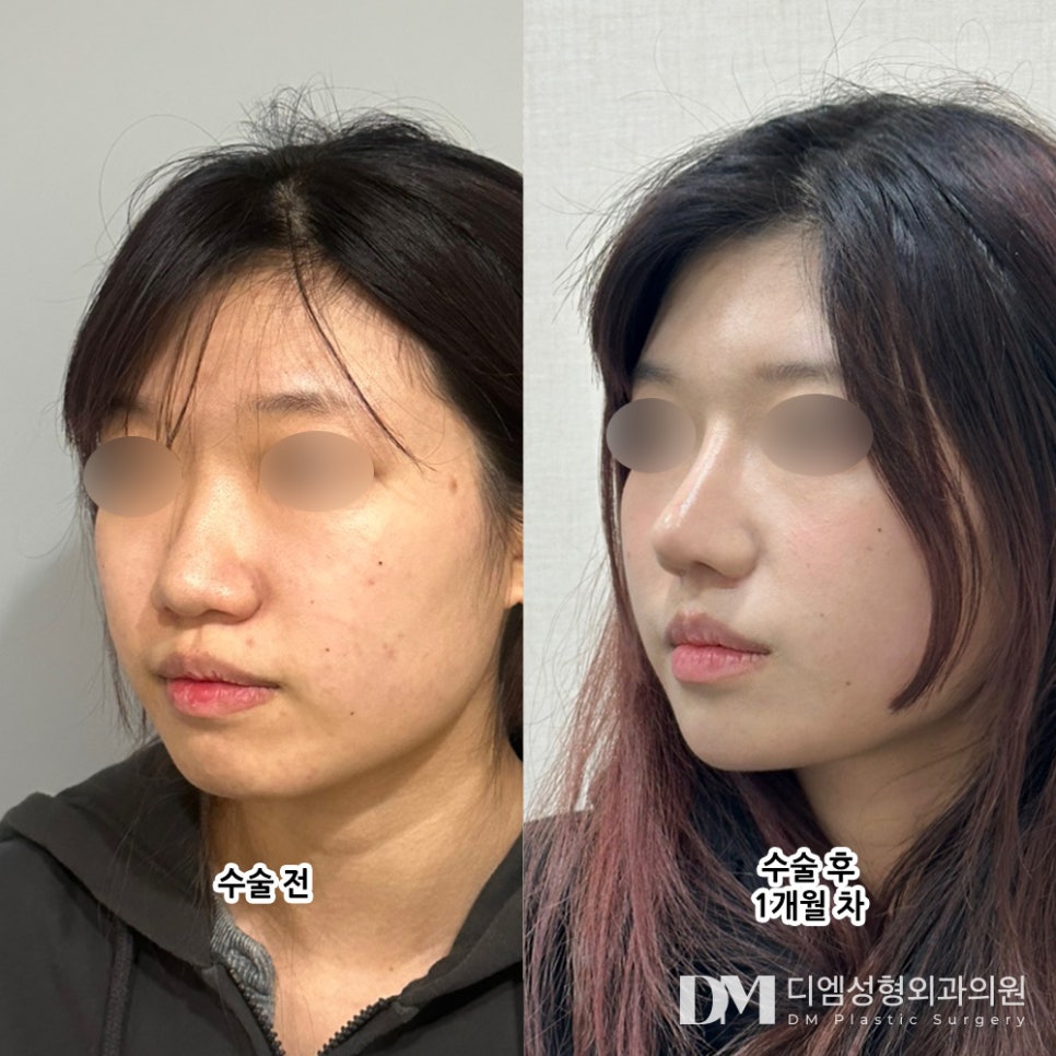 코성형 후기."주변에서 자연코 같다고 해서 마음에 들어요!" 관련 이미지 2