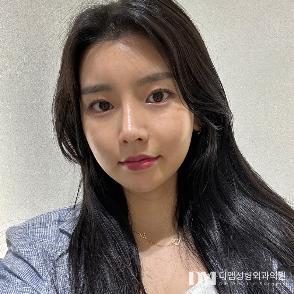 복코성형, 둔해보이는 인상에서 세련된 인상으로! 관련 이미지 1